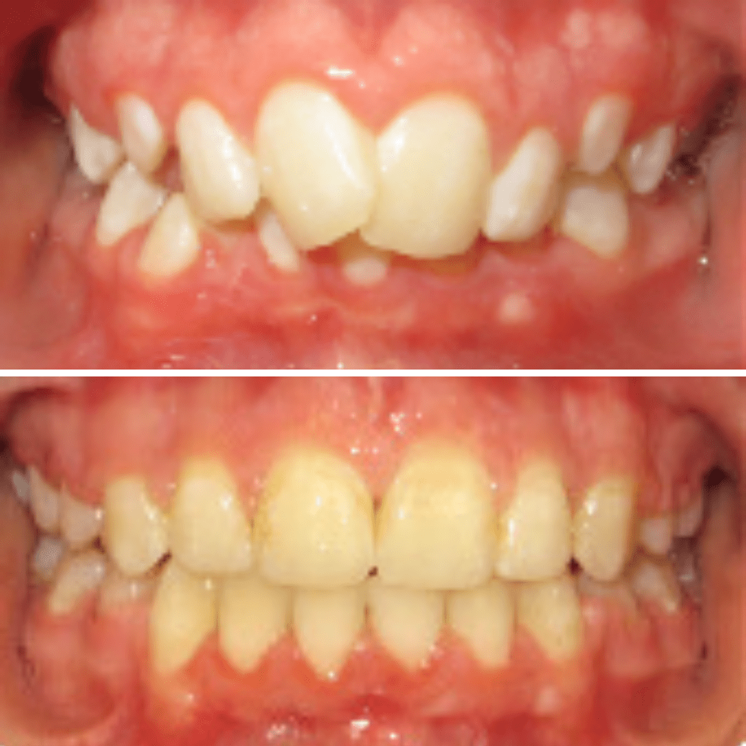 Before & After Orthodontic Treatment - BayView Orthodontics