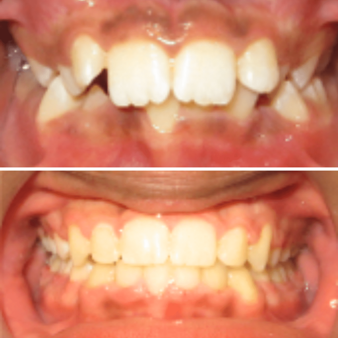 Before & After Orthodontic Treatment - BayView Orthodontics